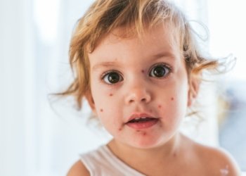 Uşaqlar arasında suçiçəyi xəstəliyi yayılıb – XƏBƏRDARLIQ