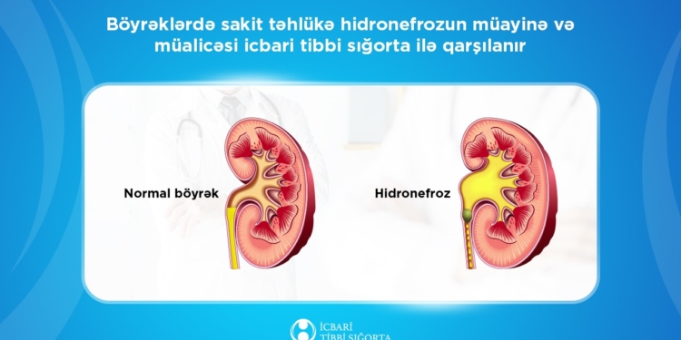 Hidronefrozun müayinə və müalicəsi icbari tibbi sığorta ilə qarşılanır